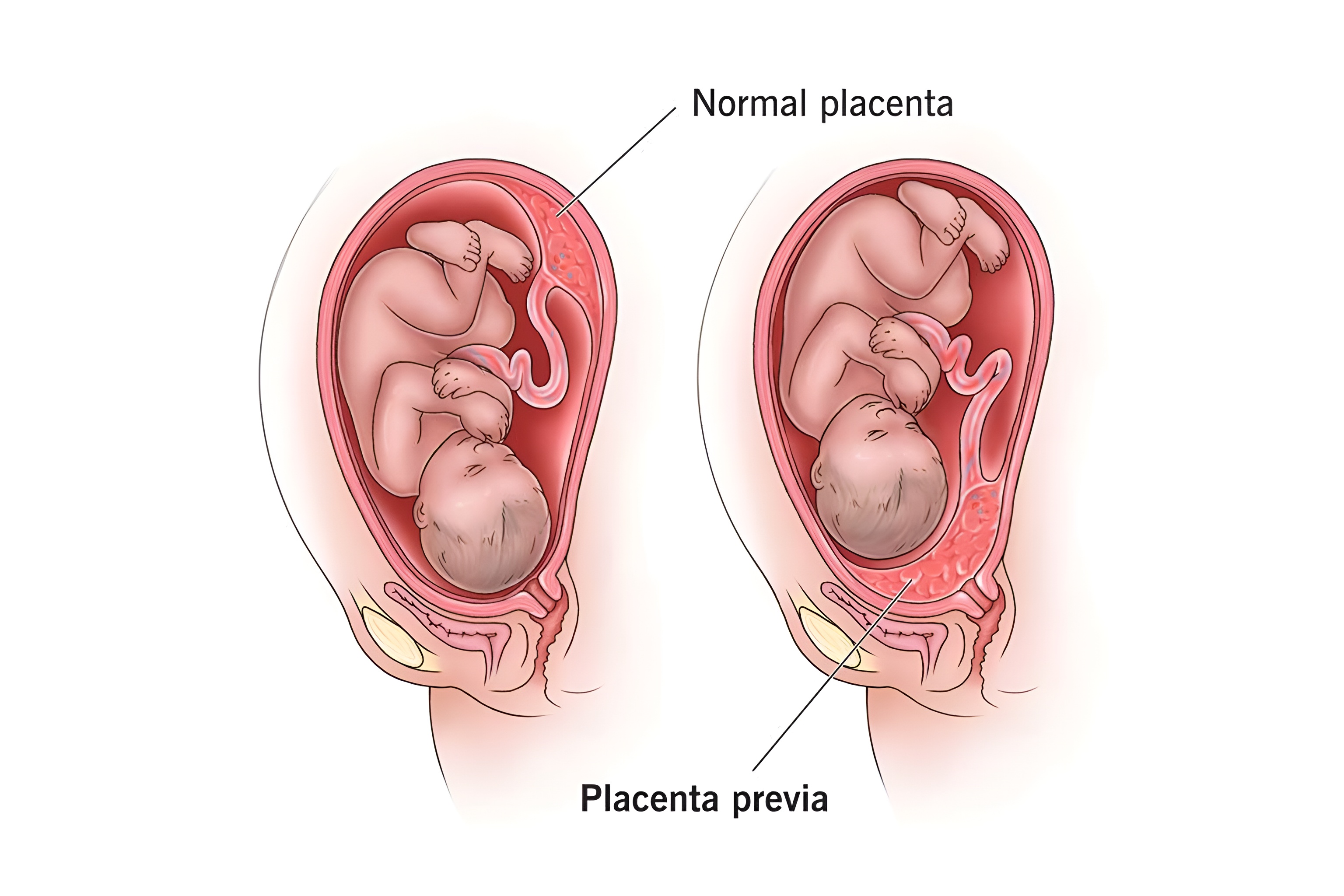 All Placenta Position Types: A Complete Guide for South Indian Mothers